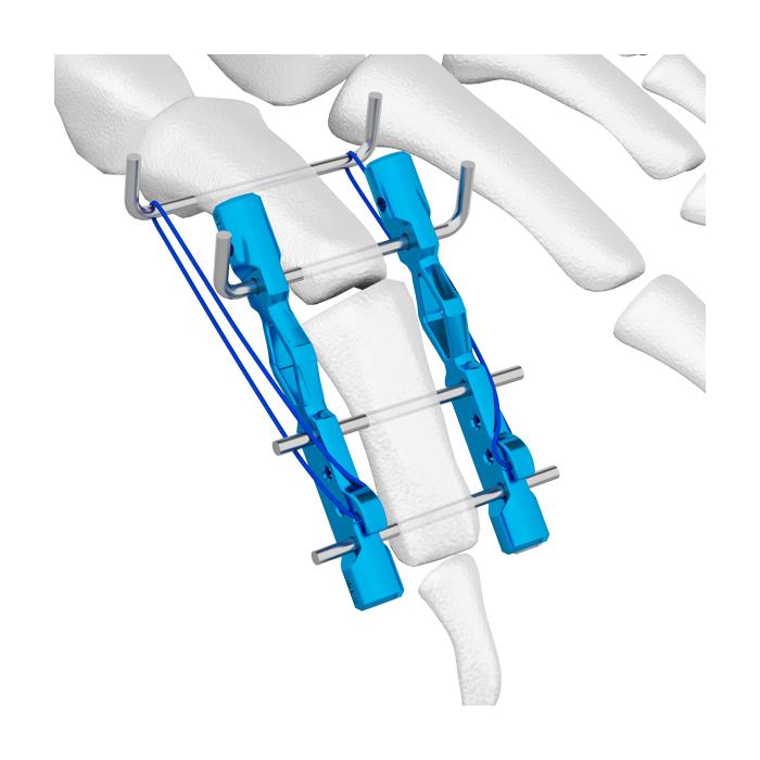 mini external fixator for Cross-articular fractures of the hand and foot