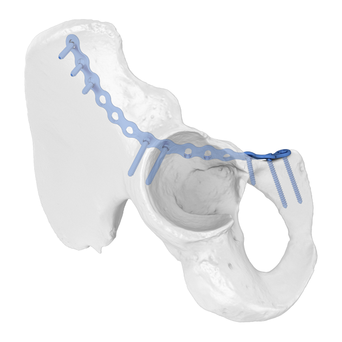FAP(Flexible Acetabular Plate) 시스템 장골 치골 전방 기둥 해부학적 잠금 플레이트
