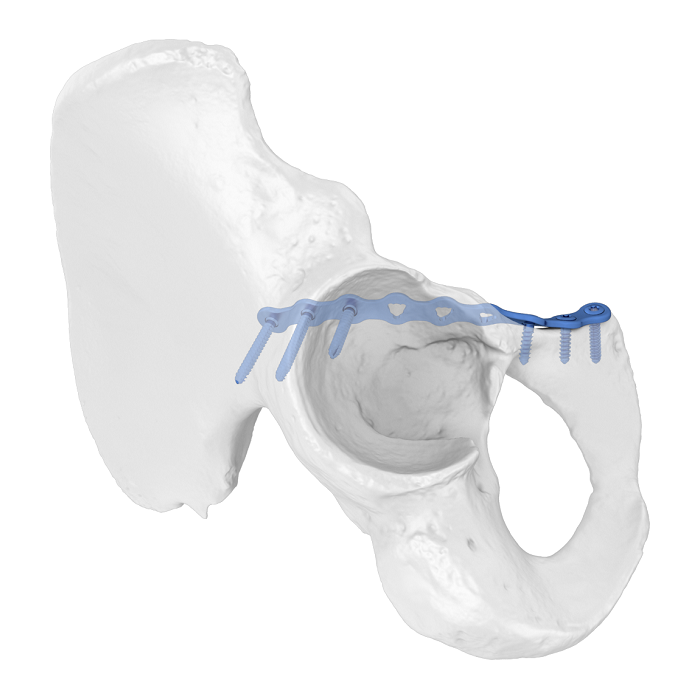FAP(Flexible Acetabular Plate) 시스템 장골 치골 전방선 해부학적 잠금 판
