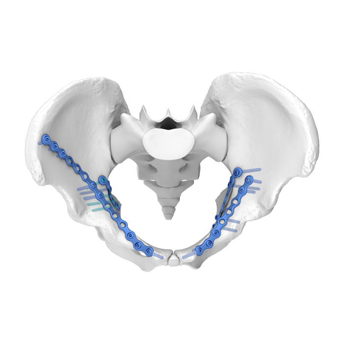 Flexible Acetabular Plate (FAP) System Iliopubic Anterior Column Anatomic Locking Plate