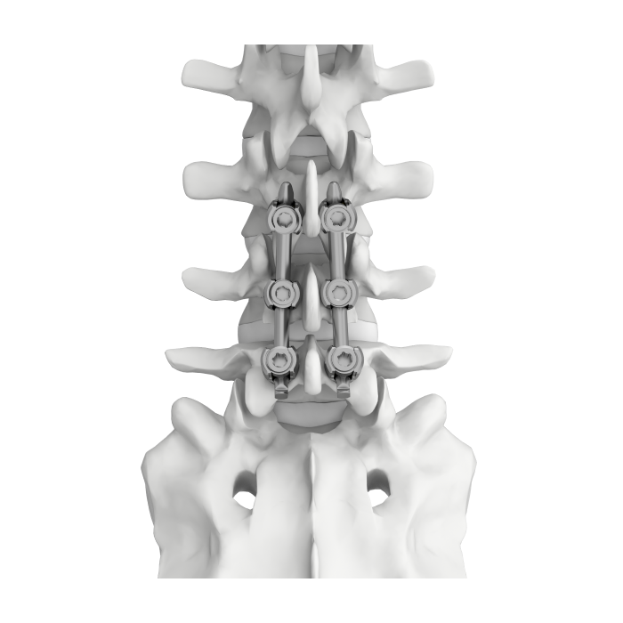 TINA Spine System