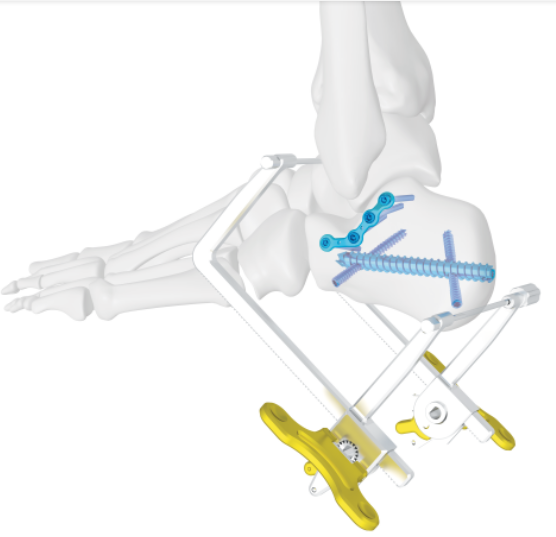 쇄골 골절의 새로운 수술 기법 - 더블 의료 쇄골 네일 시스템
