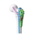 대전자 잠금 플레이트