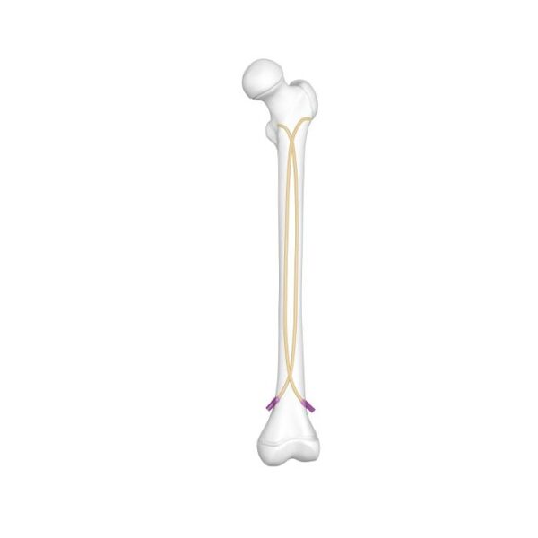 Titanium Elastic Nail