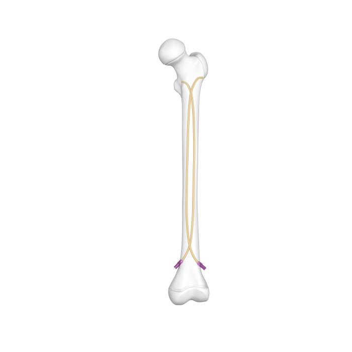 Titanium Elastic Nail